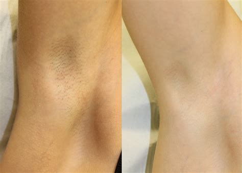 Tired of continually removing hair with traditional methods? Laser Hair Removal - Clearskin Newcastle - amazing results