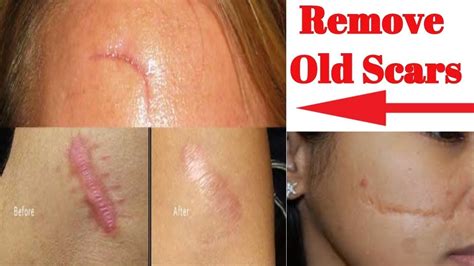 And i even have some scars from some old bites. How to Get Rid of Scars Fast, Best Scar Treatment| Home ...