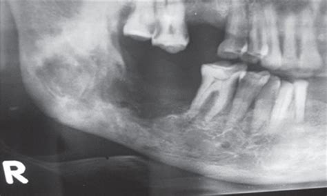 2 834 просмотра 2,8 тыс. Treatment of osteoradionecrosis of mandible with bone ...