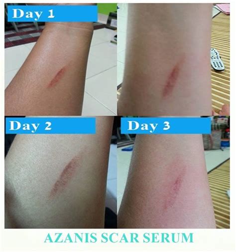 Dengan azanis scar serum hanya disapu pada parut dengan pergerakan membulat, dua kali setiap hari sudah cukup untuk menghapuskan parut tegar yang ada pada kulit anda. Testimoni Azanis Scar Serum - Parut Di Lengan