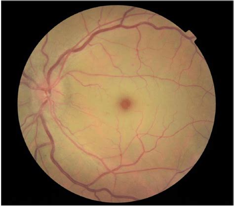 So what are those little red spots anyway? Central retinal artery occlusion: Note pale retina ...