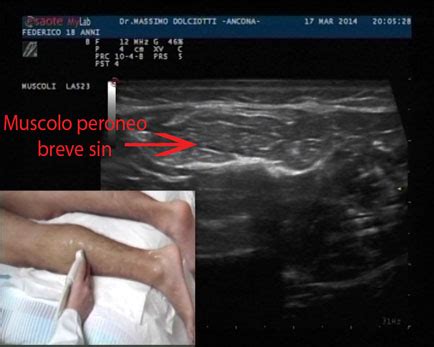 Find out all about peronei : MUSCOLI E TENDINI PERONEO BREVE E LUNGO SINISTRI