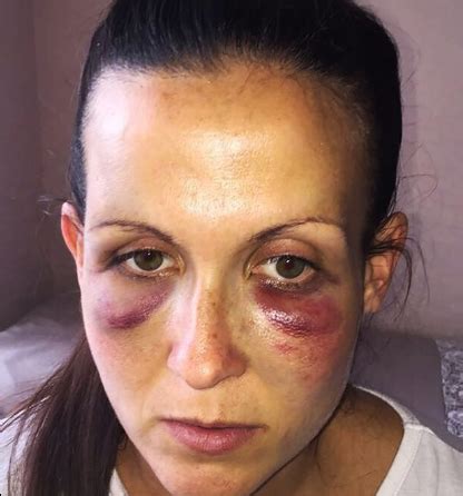 Check spelling or type a new query. New Mum Brutally Battered By Husband Three Days After ...