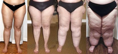 Two options exist for achilles tendon rupture, one involving surgical repair and the other a conservative treatment (allowing the tendon to. About Lipedema - aka Painful Fat Syndrome