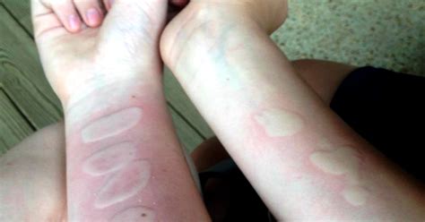 Photos tendered to the court showed a range of injuries from redness and swelling to large blisters and skin completely burnt from the students' palms. Attention Parents! The Salt And Ice Challenge Can Actually ...