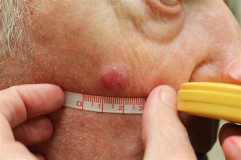 Merkel cell carcinoma (mcc) merkel cell carcinoma (mcc) is a rare type of skin cancer. Derm Challenge