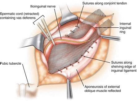 The most common shoulder injuries involve the muscles, ligaments, cartilage, and tendons. Inguinal Hernia Repair - GBMC Jordan