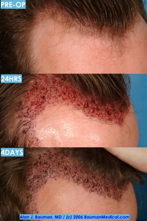 You can start washing your hair with baby shampoo, 72 hrs after surgery. Hair Transplant Recovery -- Post-Op Issues · Bauman Medical