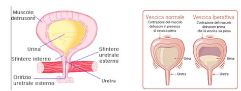 La vulvodinia ha una sintomatologia di origine multifattoriale e che quindi potrebbe differire da donna a donna, ma un sintomo comune a tutte le donne è il dolore. Vescica iperattiva e Tossina botulinica