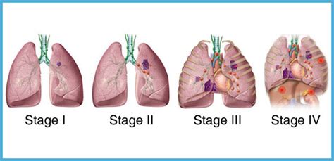 This is an early stage breast cancer. Lung Cancer Staging | Modern Cancer Hospital Guangzhou, China