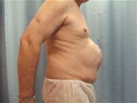 Image description not available inguinal or groin hernia. 2010 Audit - Melbourne Hernia Clinic
