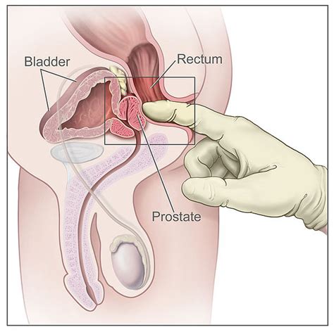 A biopsy is when a small piece of tissue is removed from the prostate and looked at under a microscope to see if there are cancer cells. Is a prostate self exam something you can do safely and ...