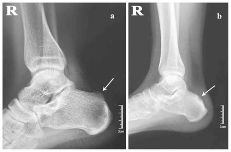 Haglund's deformity is a condition where there is a prominent posterosuperior aspect of the calcaneus. Functional follow‑up after endoscopic calcaneoplasty for ...