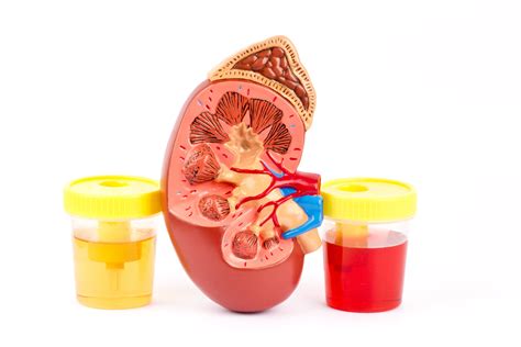 Blood in urine, or hematuria, isn't always serious but can be a sign of a number of health conditions, including those affecting the kidneys, bladder, urinary discolored urine, however, does not mean that you have blood in your urine. Haematuria (Blood in the urine)