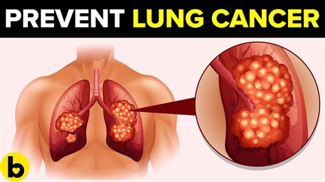 Bird flu conventional influenza fever cough sore throat the clinical behavior of other species of animals can differ. How To Reduce Your Chances Of Getting Lung Cancer - YouTube