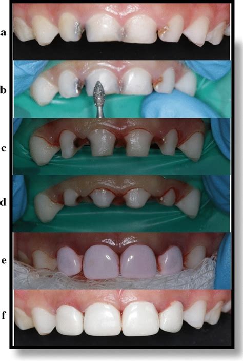 Crowns were cemented onto the resin preparations using five cementation strategies (n=15): Anterior zirconia crown's application technique. a Pre ...