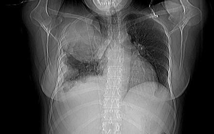 We did not find results for: Malignant pleural mesothelioma (staging) | Radiology ...