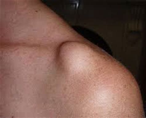 A separated shoulder is an injury to the joint that holds the collarbone and shoulderblade together. Triathlon Injury - The AC Joint