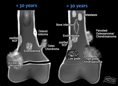 With such shocking statistics, keeping an eye out for possible symptoms of bone cancer is an absolute necessity. types of bone tumors in kids - Google Search | Radiology ...