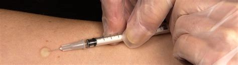 Tuberculosis (tb) is the world's top infectious killer. Tuberculosis Skin Test (PPD Skin Test) Center by ...