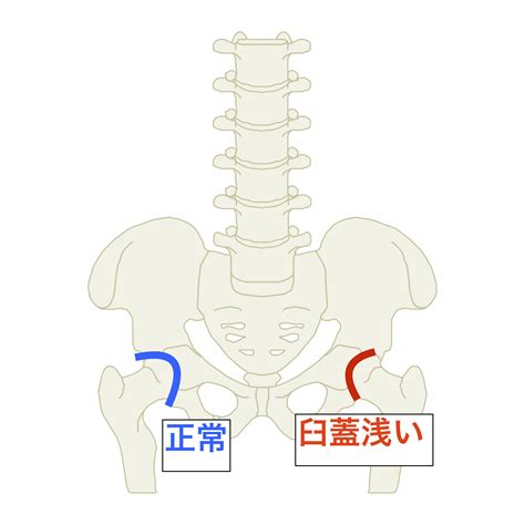 変形性股関節症の関節への負担の減らし方とは？! 痛みや ...