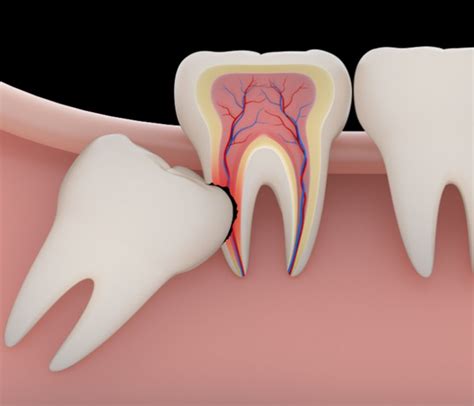 It is common knowledge that the road to recovery following a wisdom tooth extraction is a long and painful one. All about Dry Socket after Wisdom Teeth Removal - Get Fit ...