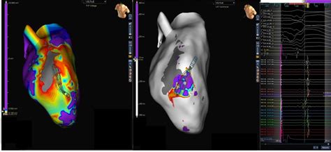 Jorge armando luna hernandez : Advisor HD Grid Mapping Catheter, SE Case Library | Abbott