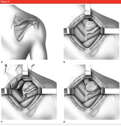 Complete recovery from snapping scapula syndrome can sometimes take 3 to 6 months, although improvement is often felt after just a few weeks. Figure 1 from Snapping scapula syndrome: diagnosis and ...