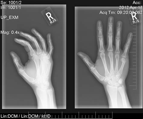 There's a whole lot of information in this article at xrays go through most metals (how much depends on how dense the metal is and how thick). Reddit, I fractured my hand defending a stranger. I don't regret my actions but I'm terrified of ...