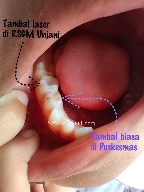 Cabut gigi geraham dan geraham bungsu perlu dilakukan jika perawatan lain tidak lagi bisa dilakukan untuk mengembalikan fungsi gigi. Harga Cabut Akar Gigi Geraham - AKARKUA