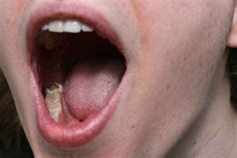 Deep cleans mouth, between teeth, and along the gum line to gently remove plaque & stains. Rotting teeth problems | General center | SteadyHealth.com