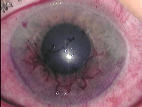 It may result in small blisters in groups often called cold sores or fever blisters or may just cause a sore throat. Ocular Herpes Simplex Part 2 - mivision