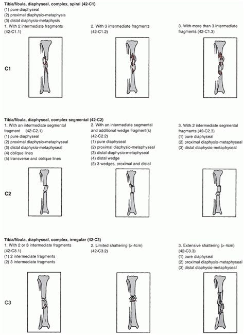 Initial management is often provided by primary care and emergency clinicians, who must therefore be familiar with these injuries. Tibia and Fibula Fractures - TeachMe Orthopedics