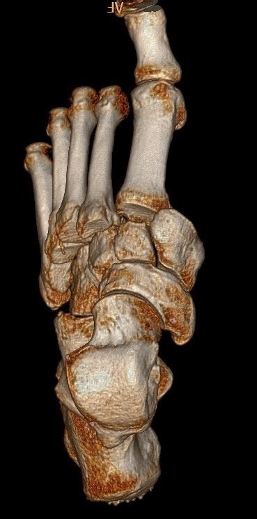 Le fratture-lussazioni di Lisfranc del piede