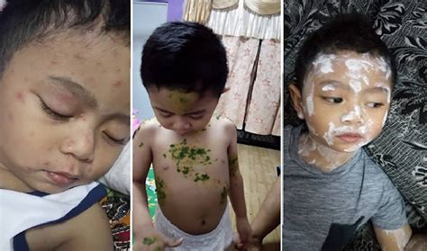 Ruqyah efektif merawat demam campak powerful ruqyah to heal chickenpox. Jangan Panik Begini Cara Cepat Mengatasi Demam Campak pada ...