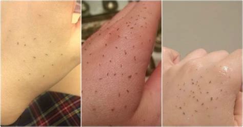 What is skin gritting? It's newest way to remove blackheads.