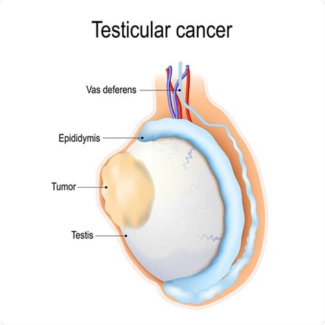 Other times, the cancer could be asymptomatic. Discussing Testicular Cancer with Your Partner