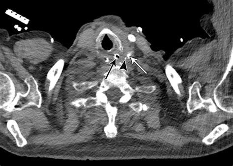 Although reduced length of stay (and therefore costs) were early drivers in er, it is now understood that er pathways reduce perioperative stress response, catabolism, and postoperative complications. Esophagectomy and Gastric Pull-through Procedures ...