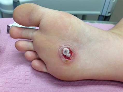 Warts can grow on all. TORONTO FOOT BLOGGER - FOOT SPECIALIST, PODIATRIC MEDICINE ...