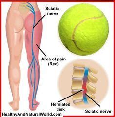 Sciatica pain can be close to paralyzing—a numb, tingling or burning sensation going down in the back of it can also compress the sciatic nerve and as a result, you feel the sciatica pain. Pin on Fitness