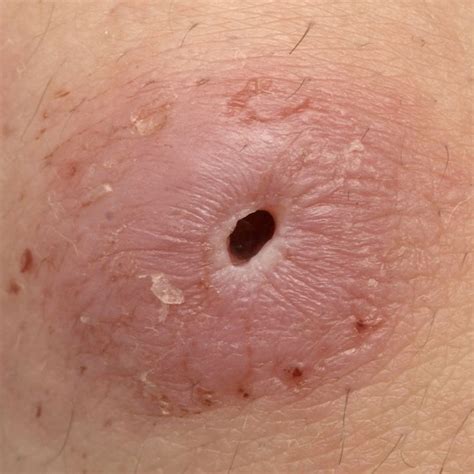 Novel porcine model of cutaneous myiasis: a training tool ...