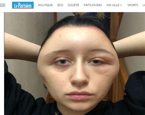 Fa una tintura per capelli e ha una reazione allergica ...