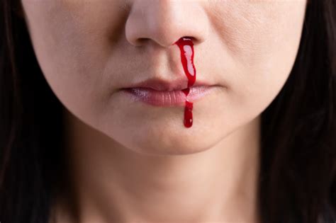 Nosebleeds can be annoying and sometimes scary, especially if you have a bleeding disorder. Premium Photo | Nosebleed, woman with a bloody nose ...