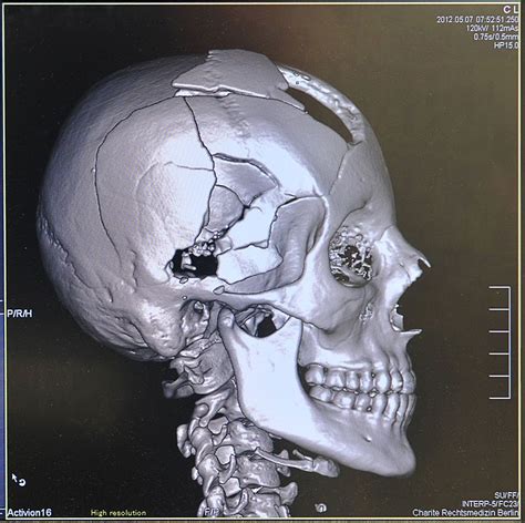 Entry and exit wound with tract through the brain parenchyma · tangential: Virtopsy 3D Post mortem CT reconstruction: gunshot wound ...