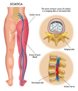 Slipped discs—technically known as lumbar disc herniations—are a common source of sciatica (radiating pain down the legs) in the young and a slipped disc is like squeezing a jam doughnut: What Can Jelly Doughnuts Teach You About Bulging and ...