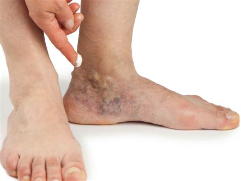 On rare occasions, an interior leg vein becomes varicose. Things you Should Know about Bleeding Varicose Veins | All ...