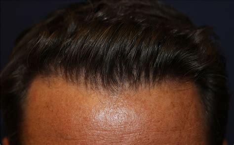 From hair transplants to hair. Hair Transplant Before and After Photos by Richard Chaffoo ...