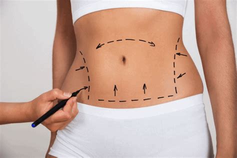 View plastic surgery financing options with dr. How to Get Plastic Surgery Finance Help with Bad Credit ...