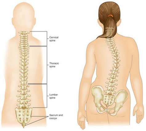 It could be growth of a single rib unilaterally or a pair of ribs bilaterally. la-scoliose - Home