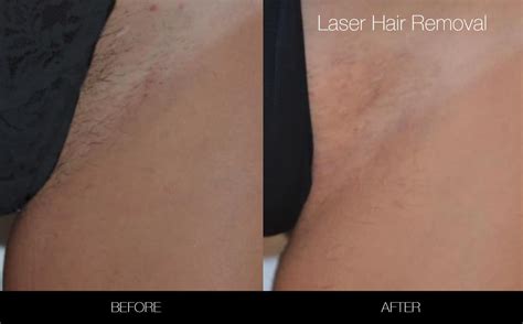 Brazilian waxes are popular but extremely painful. Brazilian Laser Hair Removal in Toronto | SpaMedica